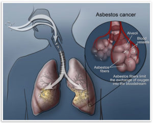 asbestos exposure