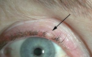 basal cell skin cancer